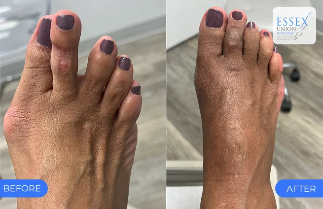 Bunion with crossover toe — before and after results at Essex Union Podiatry