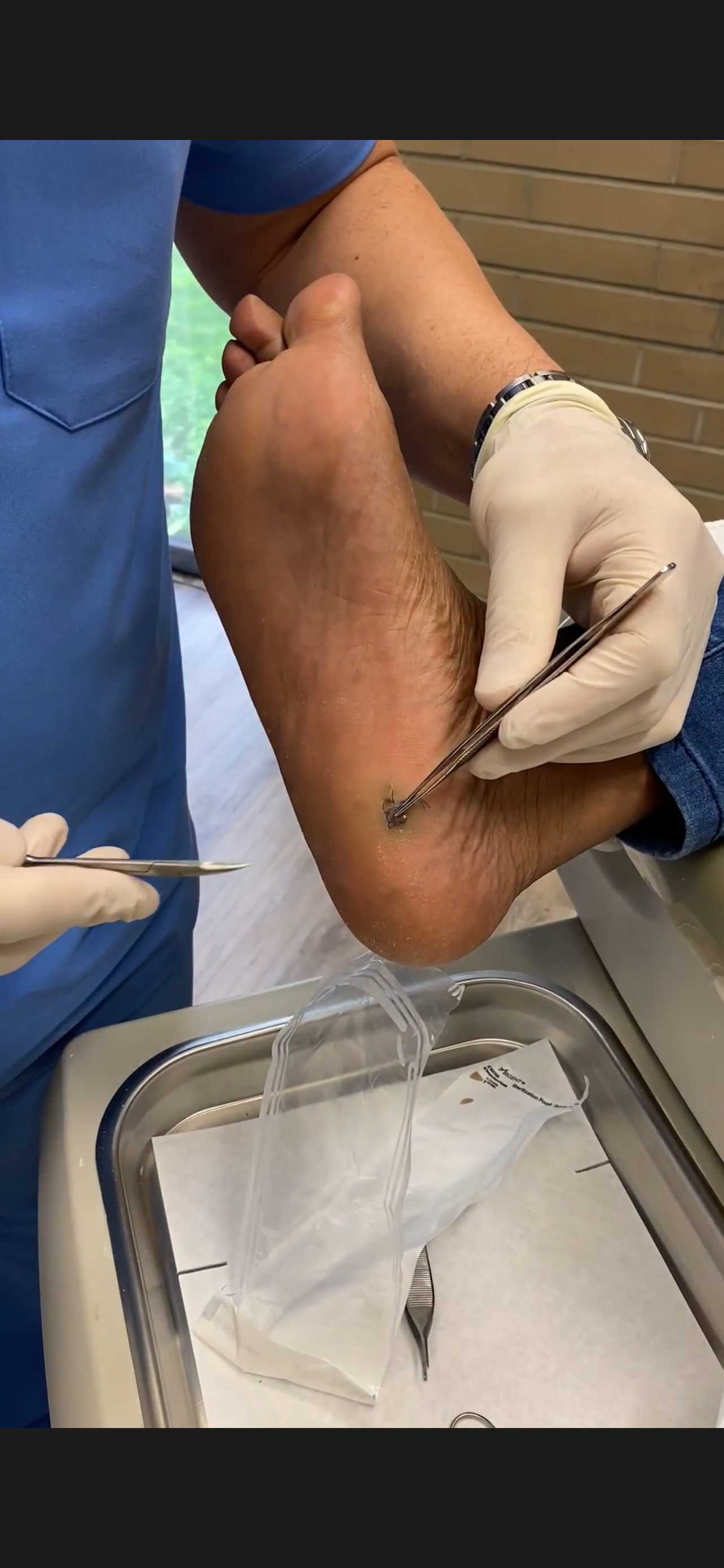 Heel pain and tendinitis treatment